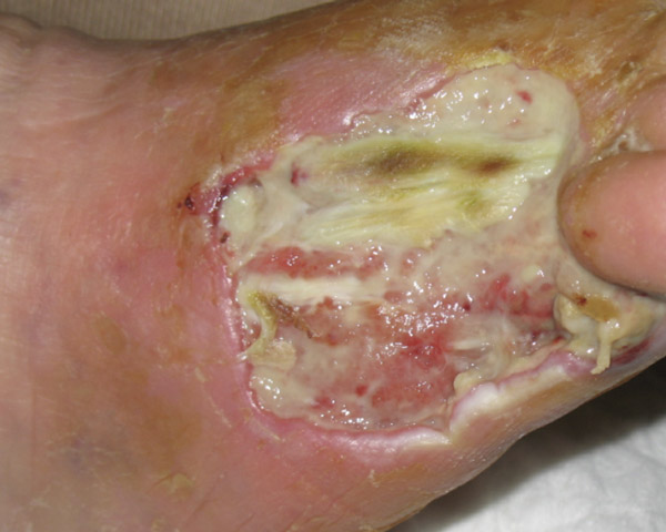 PAD - Post amputation wound