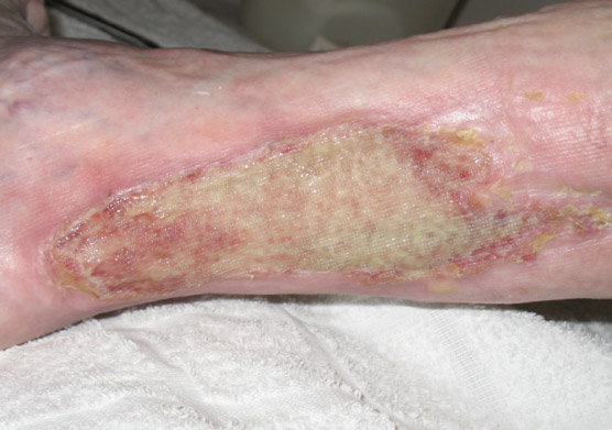 Colonized exuding wound