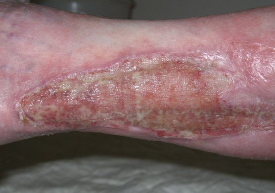 Colonized exuding wound