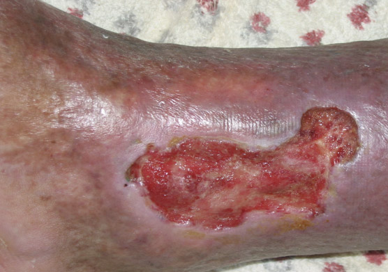 Dry detergent ulcera