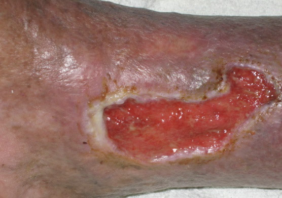 Dry detergent ulcera