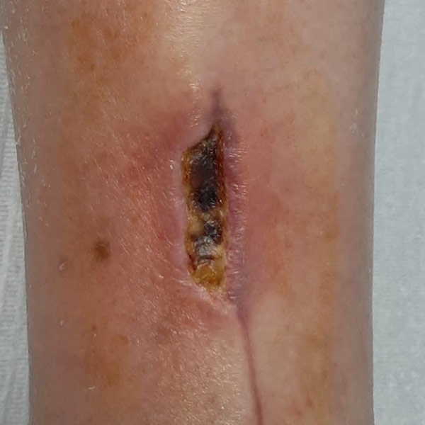 60 days after surgery