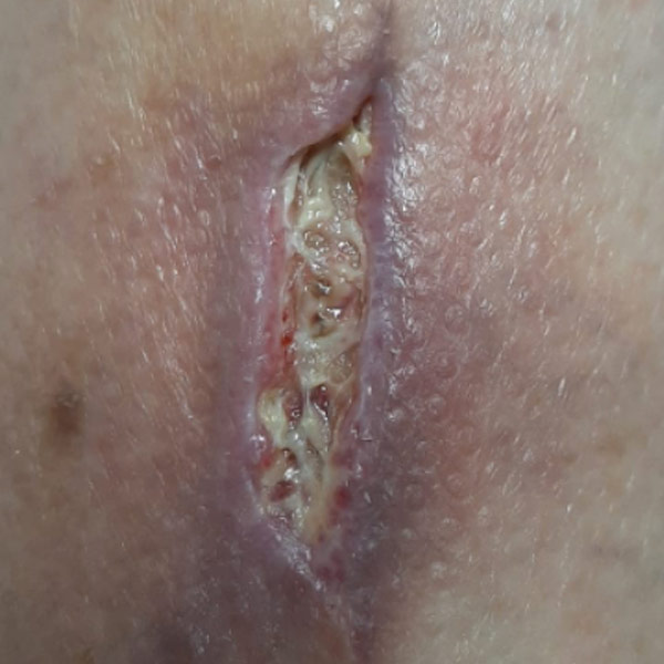 12 days after 1st approach - change to Vulnamin Cream (72 hours)