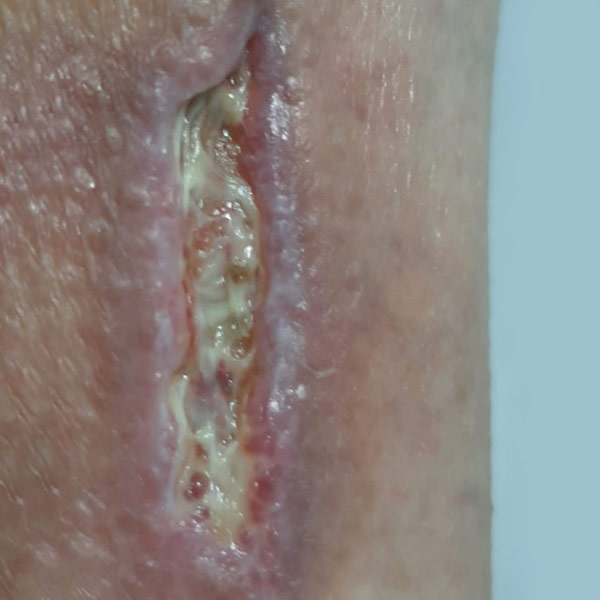 15 days after 1st approach